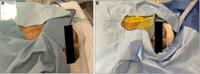 Carotid endarterectomy using regional anesthesia: technique and considerations